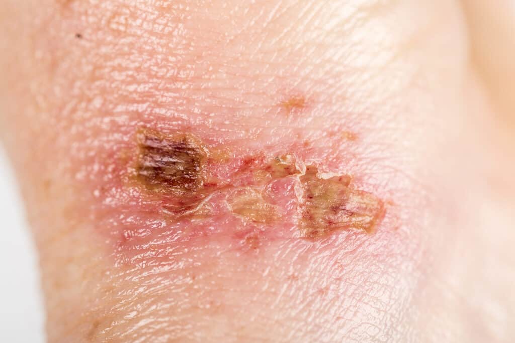 Chemical Burn On The Wrist Skin With Hydroxide Sodium Acid